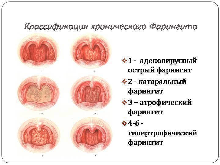 Красное горло: виноват вирус или бактериальная инфекция?