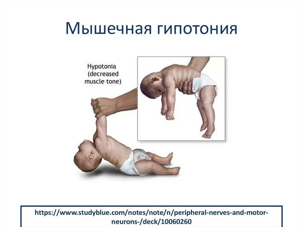 Гипертонус мышц у грудничков: признаки, лечение | fok-zdorovie.ru
