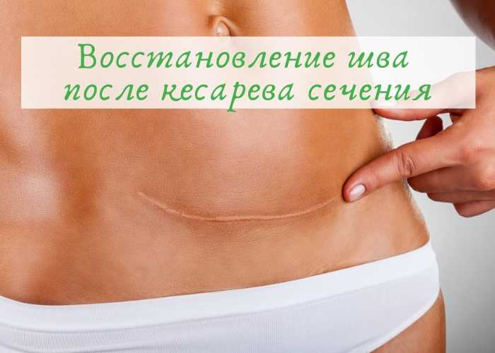 Как правильно ухаживать за швом после кесарева сечения