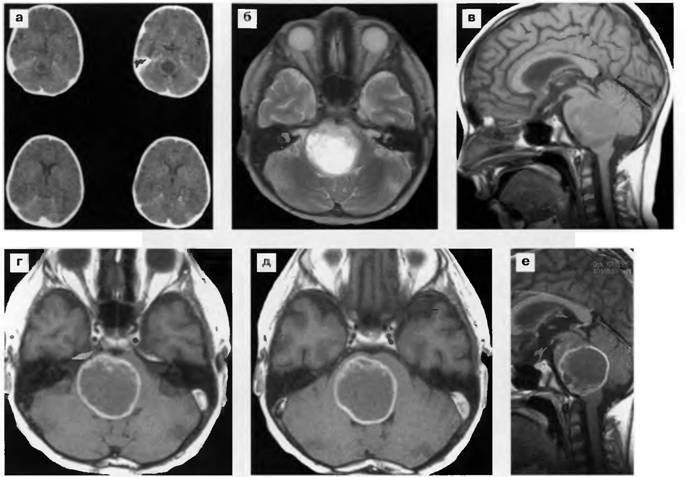 Глиома / астроцитома (i – iii стадии) головного мозга: причины, симптомы, лечение | клинический госпиталь нейровита