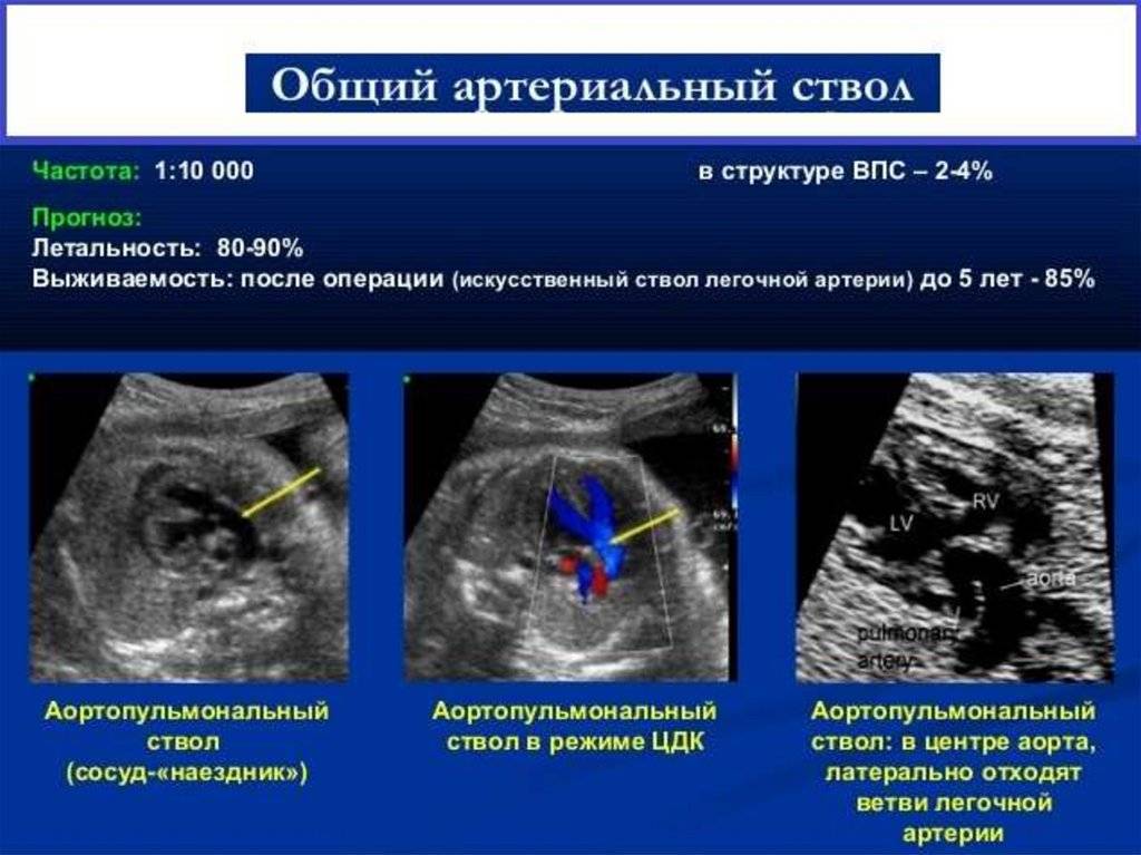 Врожденный порок сердца у новорожденных — классификация, симптомы, лечение