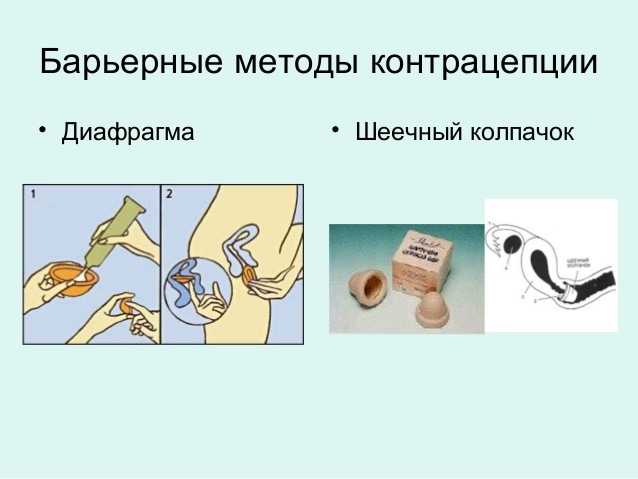 Презерватив, диафрагма, фемидон, шеечный колпачек - механические методы контрацепции