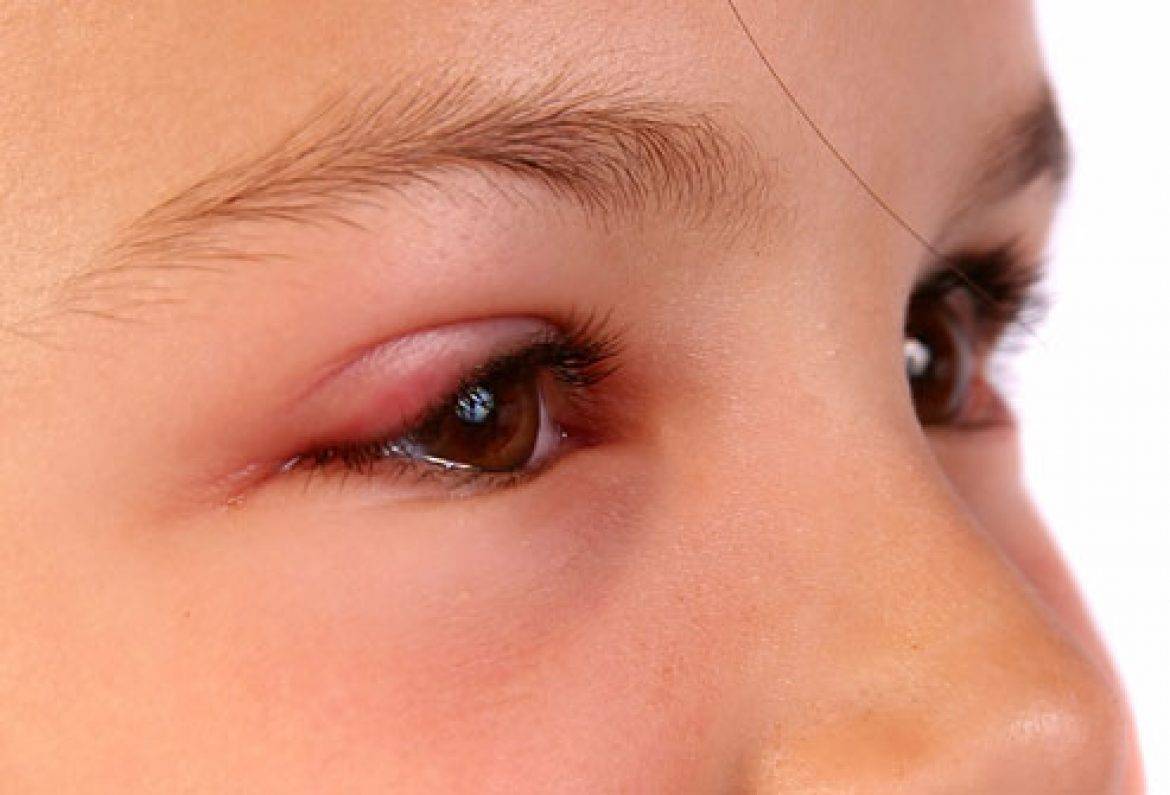Что делать, если ребенка укусил комар или другое насекомое и весь глаз опух: как снять отек века после повреждения?