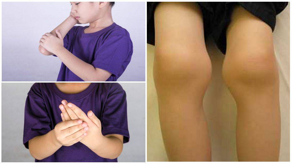 Артрит коленного сустава у ребенка: симптомы и лечение