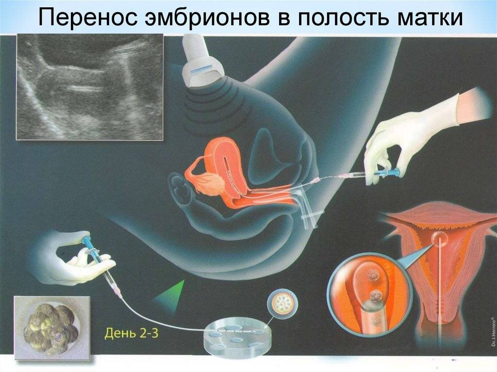 Можно ли забеременеть со спайками в матке или трубах и как протекает беременность?