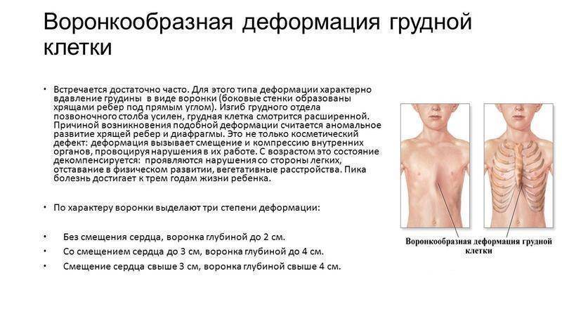 Деформация грудной клетки у ребенка - килевидная и воронкообразная: фото, лечение, массаж на видео