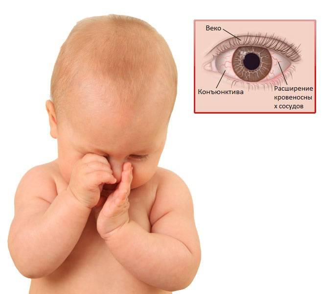 Закисают глаза у ребенка: причины, лечение для младенцев и детей после года