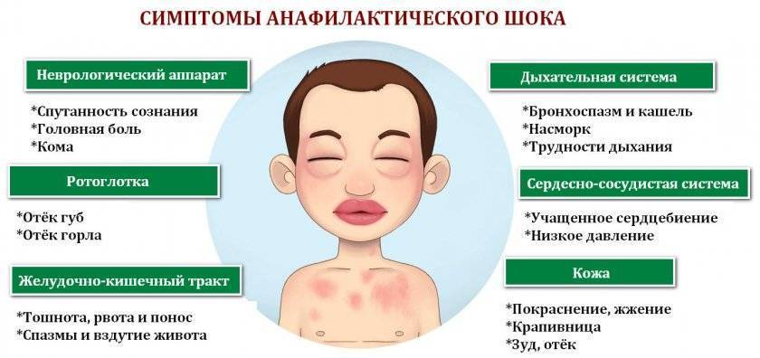 Крапивница: причины, симптомы, лечение у детей и взрослых