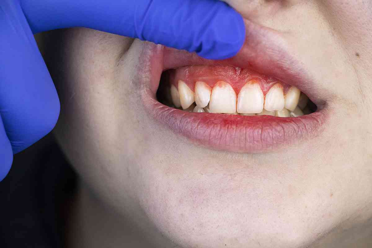 Синяя десна при прорезывании зубов у ребенка: гематома, синяк, шишка, лезет зуб.