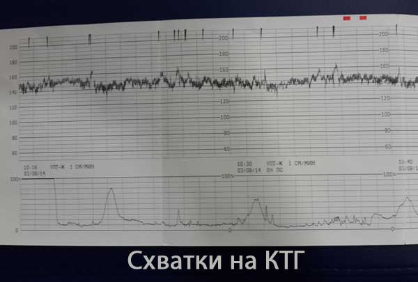 Как можно заметить начало схваток при проведении ктг