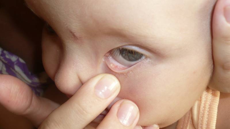 Гноятся глаза у ребенка - чем промыть и как лечить медикаментозными или народными препаратами