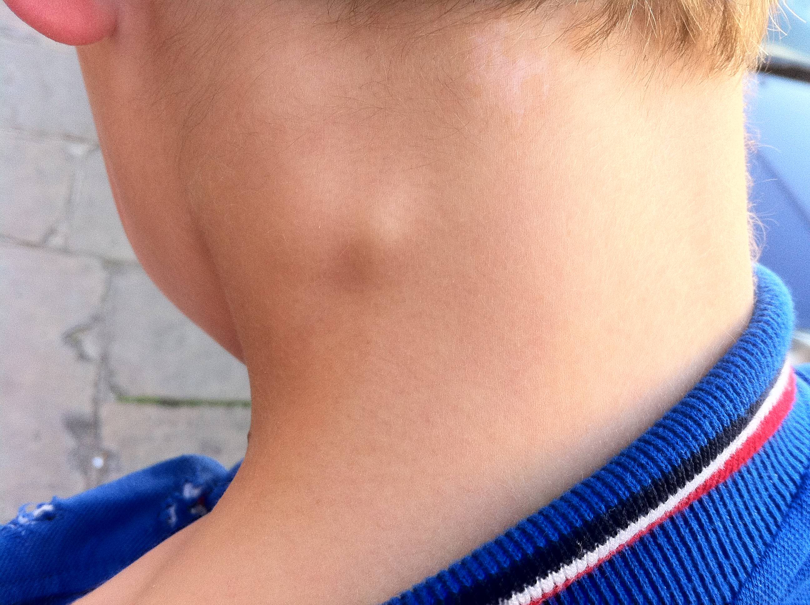 У ребенка на шее шишка под кожей: что это может быть за шарик и как его лечить?