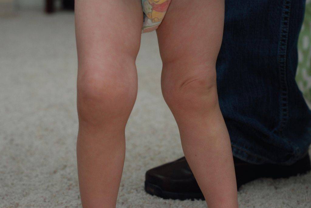 Артрит коленного сустава у детей: симптомы и лечение у ребенка, причины