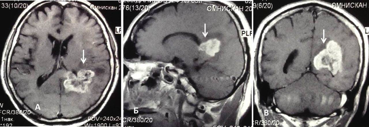 Диффузная глиома головного мозга - симптомы и лечение