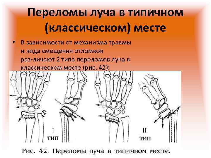 Перелом руки у ребенка: как определить, симптомы и лечение