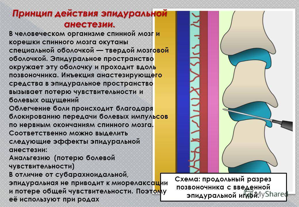 Спинальная и эпидуральная (перидуральная) анестезия — в чем разница? применение, противопоказания, возможные осложнения