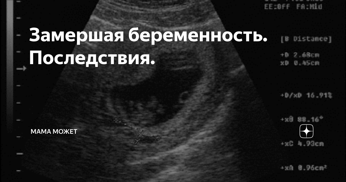 Замершая беременность на ранних сроках после процедуры эко: причины и признаки