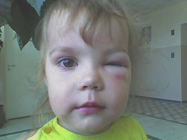 Ребенка укусил комар в глаз, все опухло: что делать, как снять отек века после насекомого?