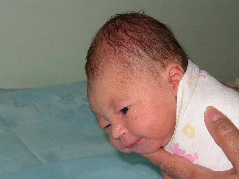 Гематома у новорожденного на голове после родов