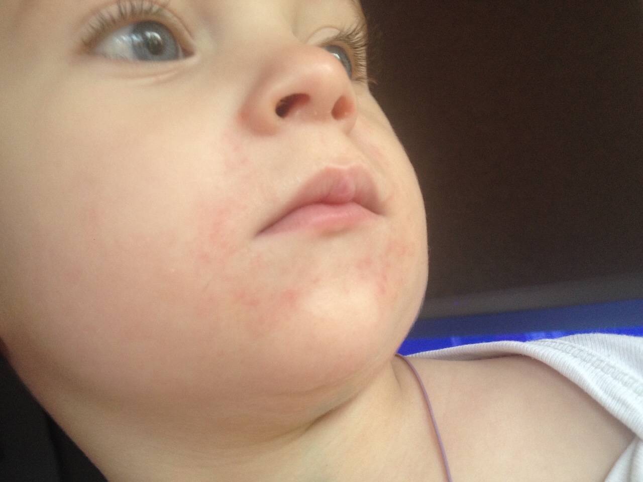 Сыпь на подбородке у ребенка: почему появляется раздражение и аллергия вокруг рта и что делать?