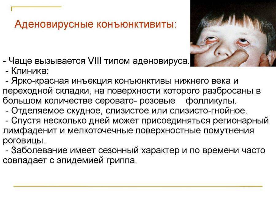 Причины возникновения конъюнктивита у детей до года