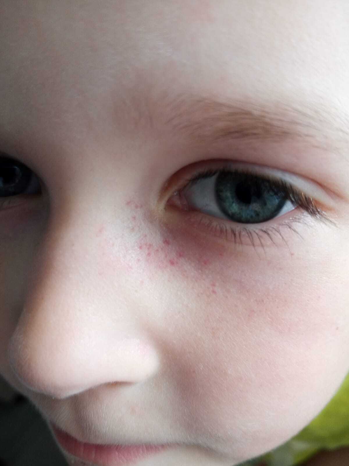 Причины возникновения красных кругов, точек или пятен под глазами у ребенка