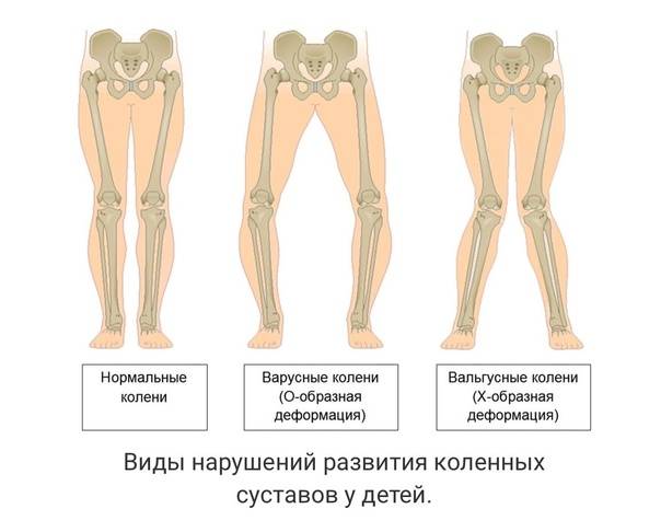Вальгусная деформация коленных суставов у детей и взрослых: фото, лечение, отзывы