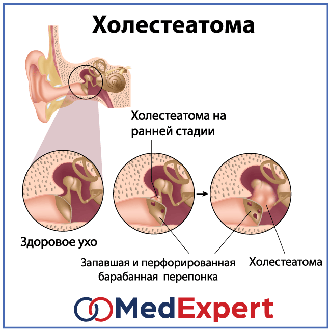 Кровь из уха: причины появления после чистки ватной палочкой или расчесывания у взрослого и ребенка или что делать при этом