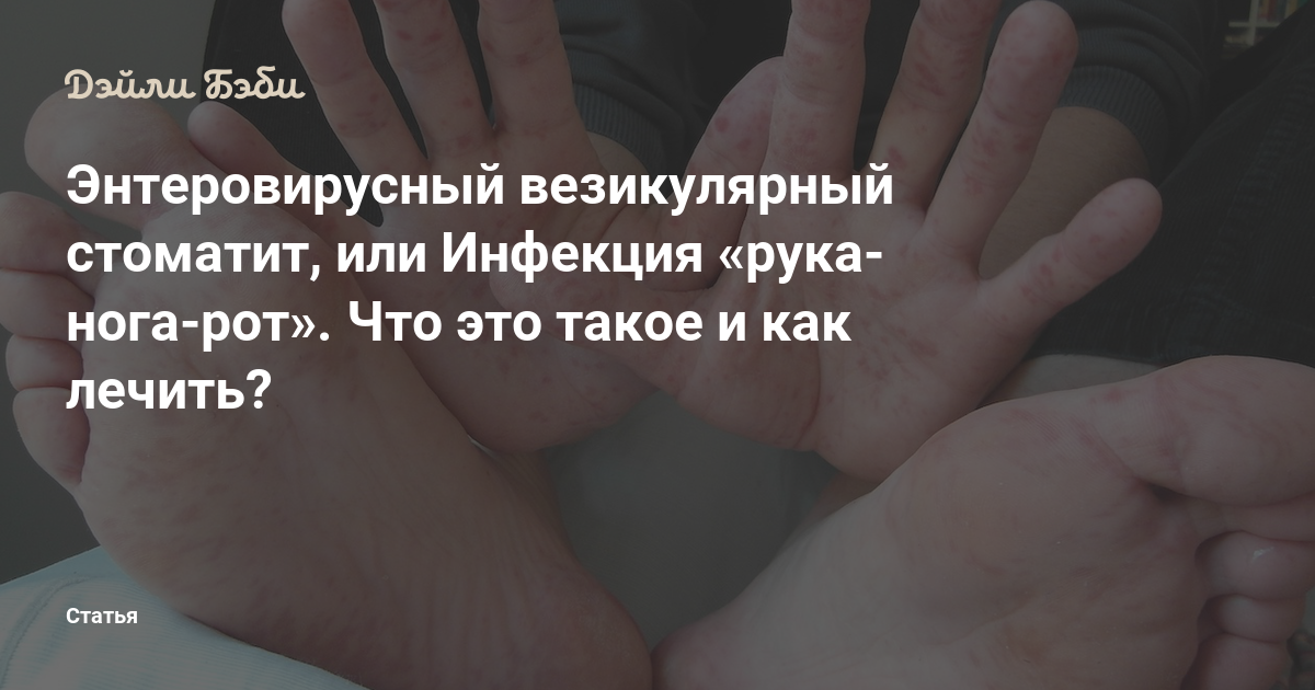 Лечение зубов - стоматит - энтеровирусный везикулярный стоматит — лечение синдрома «рука-нога-рот», с экзантемой