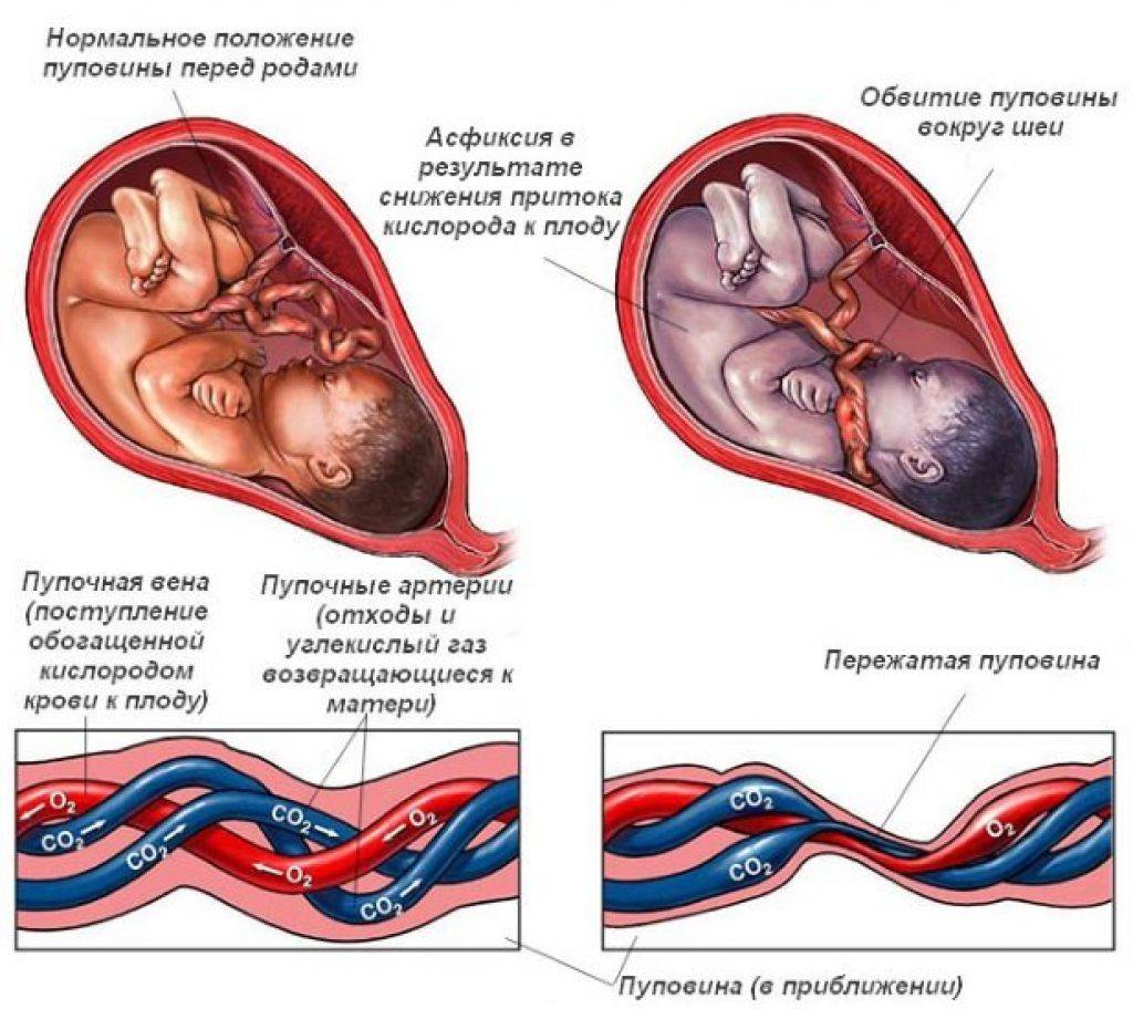 Обвитие пуповиной: опасности и последствия для малыша | курсы и тренинги от лары серебрянской