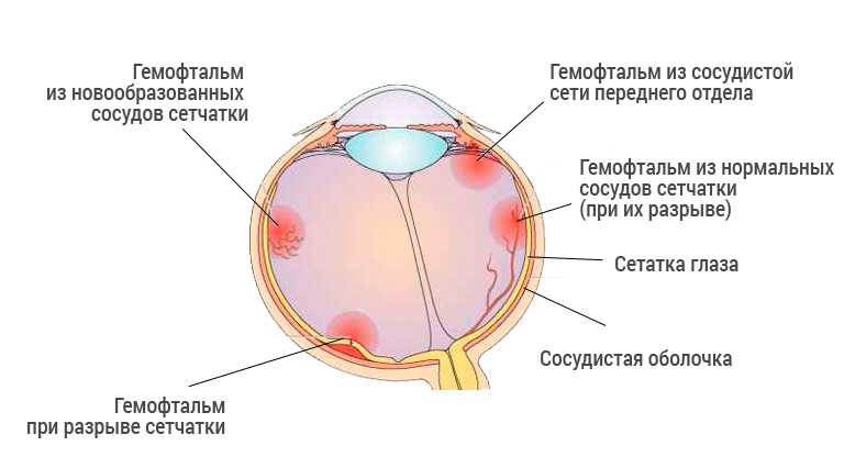 Почему может лопнуть сосуд в глазу и что с этим можно сделать
