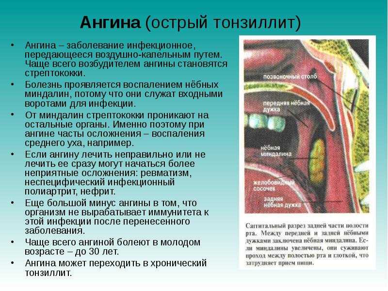 Герпетическая ангина у детей