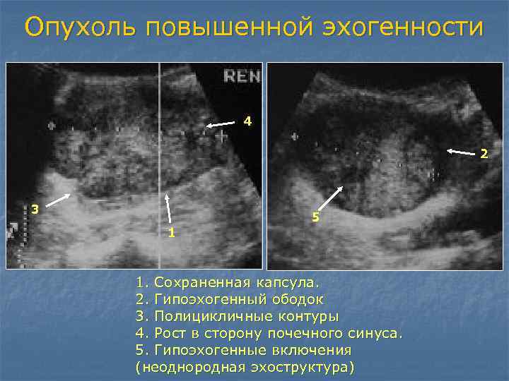 Гиперэхогенный кишечник у плода: что это?