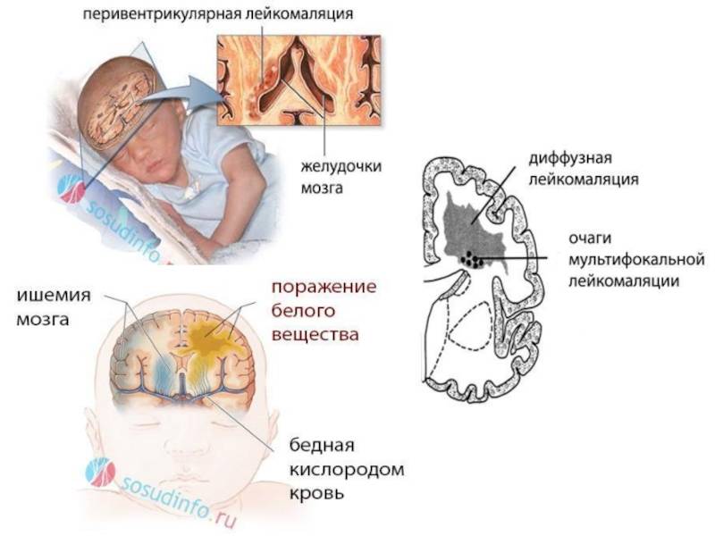 Лечение гематомы у новорожденного на голове после родов, последствия травмы для ребенка