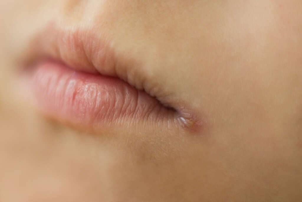 Заеды в уголках рта: причины и лечение ангулярного стоматита