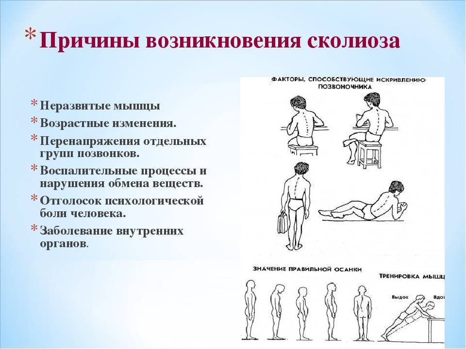 Эффективное лечение сколиоза 1 степени: советы специалистов