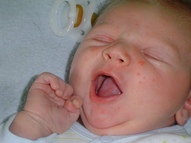 Аллергия у грудничка, новорожденного: как выглядит и проявляется, фото