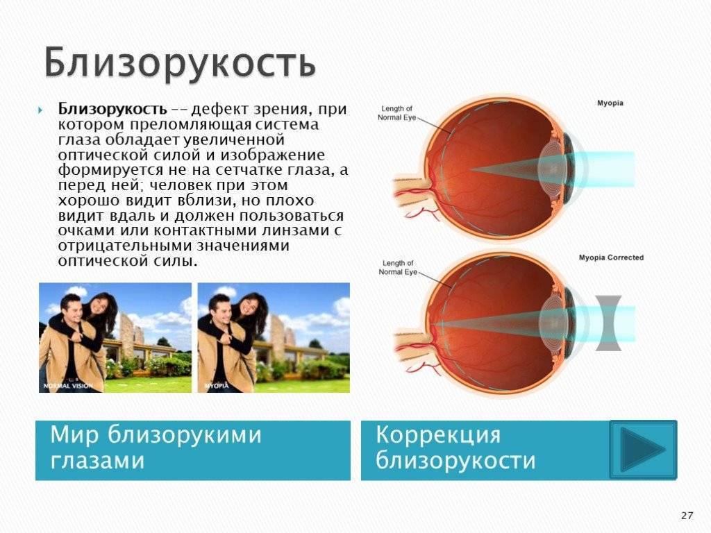 Близорукость у детей: лечение миопии разной степени, профилактика в домашних условиях