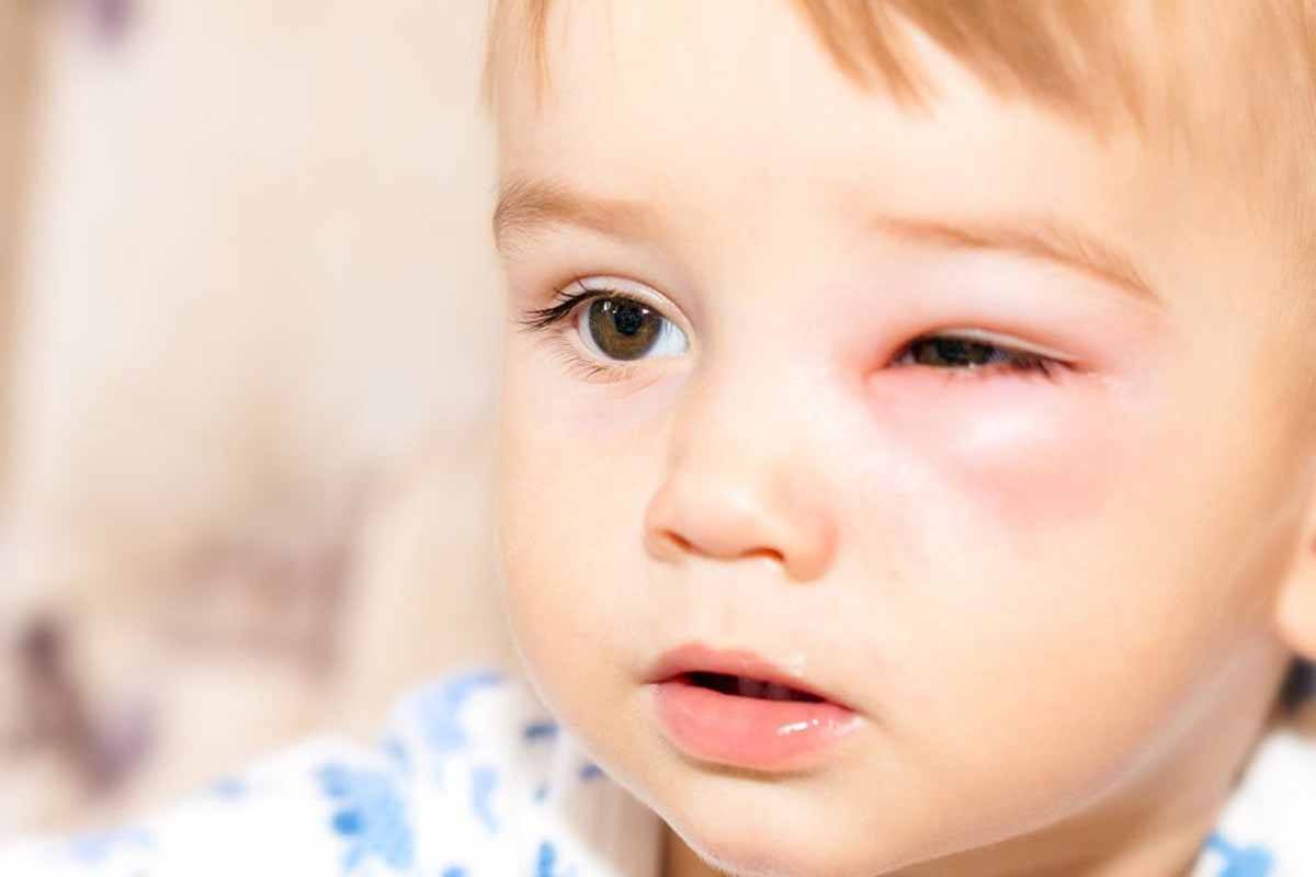 Что делать если в глаз укусила мошка - отек и опух глаз после укуса, чем снять опухшесть глаза у ребенка и взрослого
