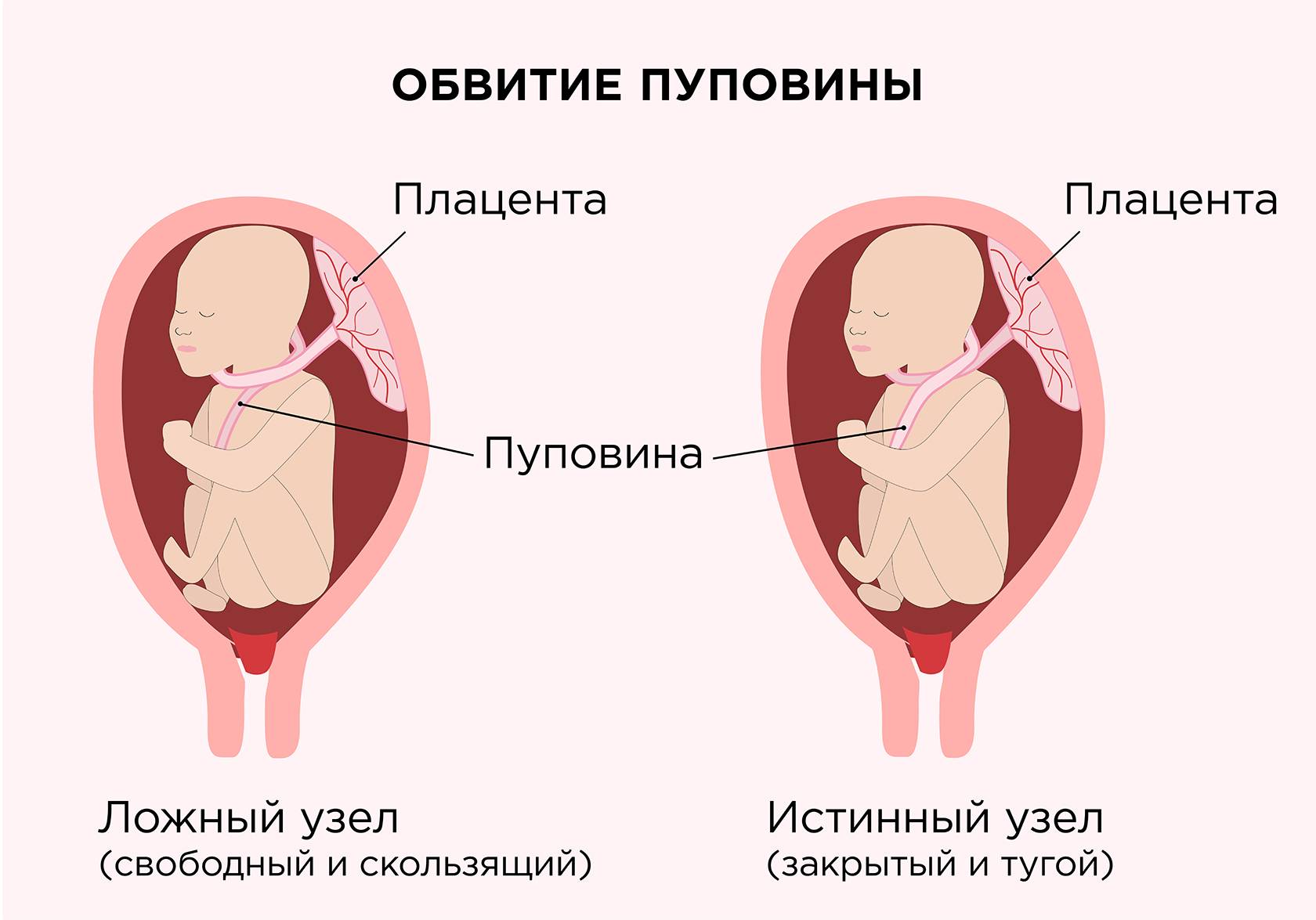 Пуповина плода: что это такое и как образуется, какой длины должна быть в норме и для чего нужна, как выглядит?