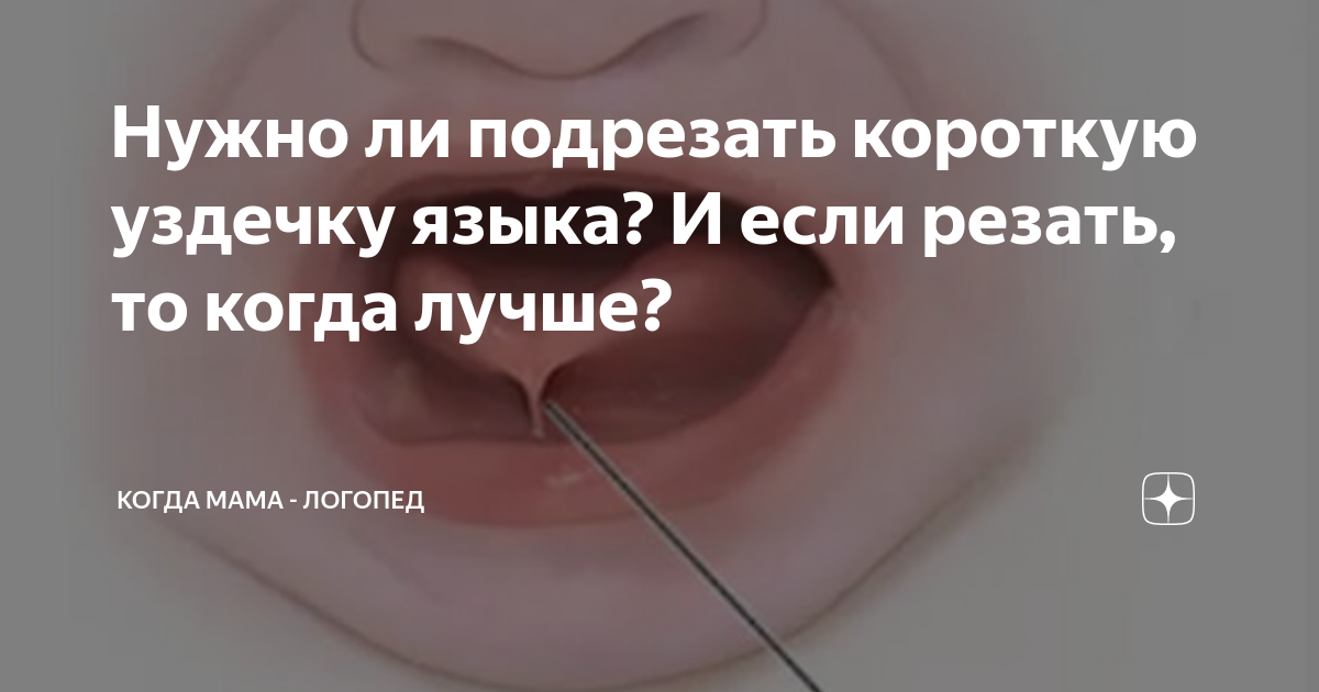 Короткая уздечка языка. подрезать или растягивать?