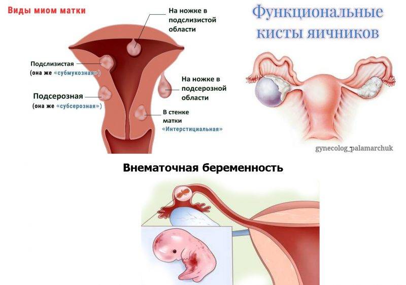 Свечи во время месячных: можно ли ставить суппозитории в период менструации?