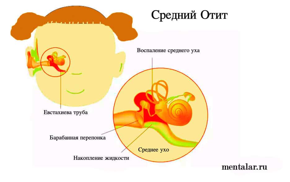Отит у ребенка: симптомы, причины и эффективные методы лечения