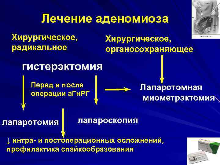 Аденомиоз матки: 6 причин, 5 способов лечения, развитие беременности