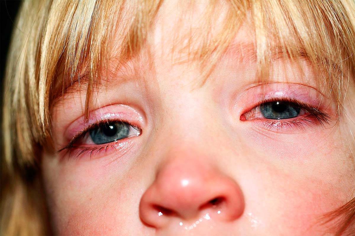 Аллергический конъюнктивит у детей: симптомы, причины и эффективное лечение