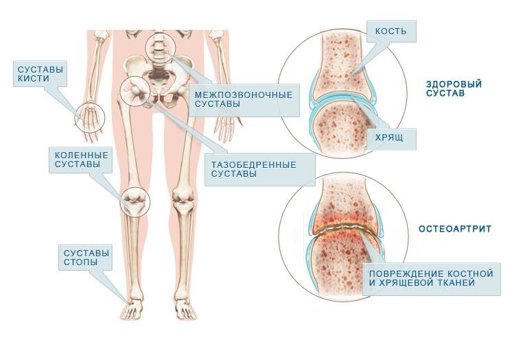 Артрит коленного сустава у детей: причины, симптомы, лечение