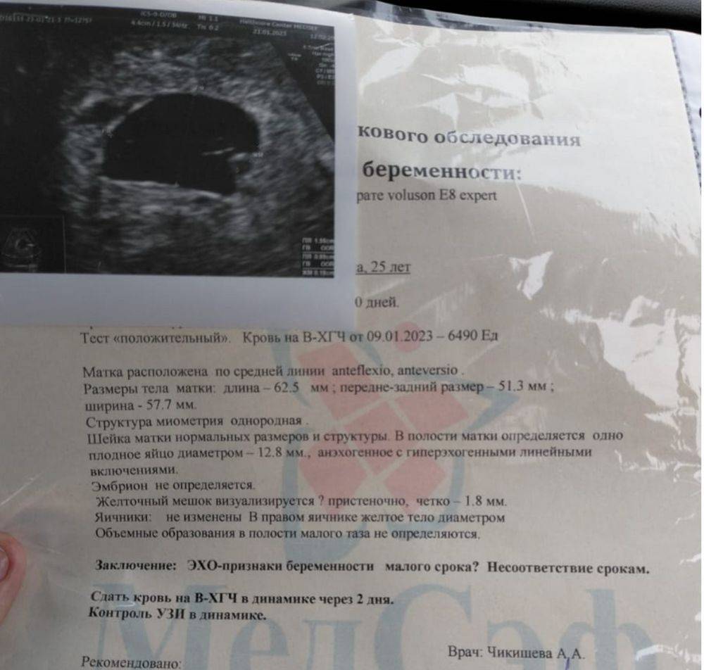 Плодное яйцо без эмбриона, анэмбриония: признаки и лечение