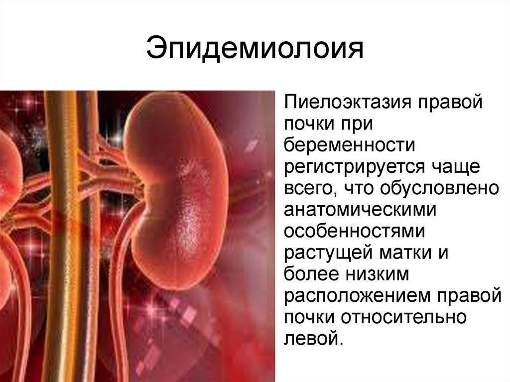 Пиелоэктазия почек у плода: причины, лечение и осложнения