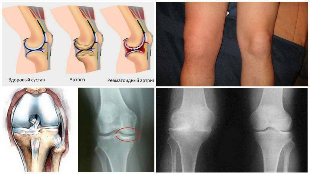 Реактивный артрит коленного сустава у детей: причины, симптомы и лечение