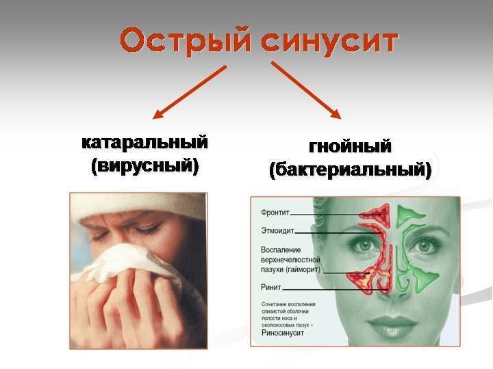 Синусит: симптомы и лечение у детей в домашних условиях, профилактика